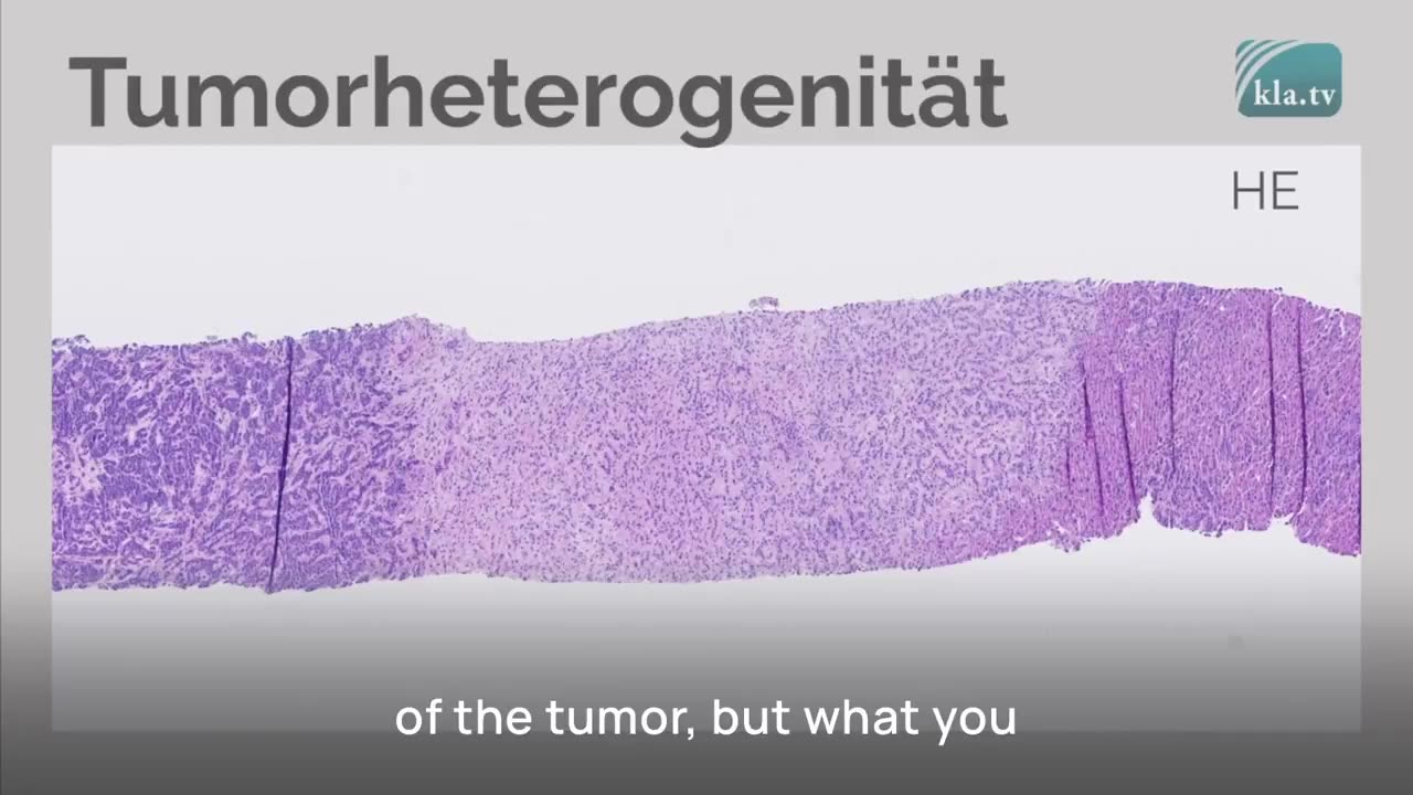 Dr. Ute Krüger on Tumor Correlation After Vaccinations