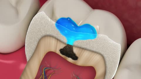 Dental Surgery 3D Animation (Cavity Filling)