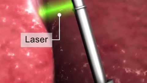 Enlarged Prostate Gland Surgery 3D Animation - Transurethral resection