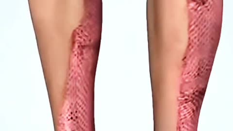 Skin Graft Surgery – Restoring Damaged Skin with Advanced Medical Techniques.
