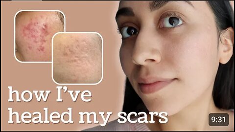 Healing Hyperpigmentation + Deep Pitted Acne Scars (this is what I’ve done)