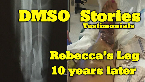 Dmso stories: Rebecca's leg, 10 years later