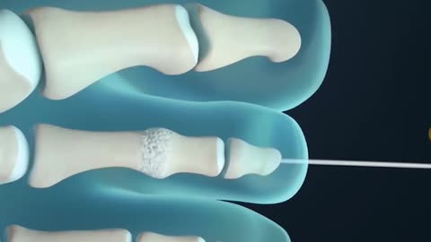 Hammer Toe Surgery 3D Animation