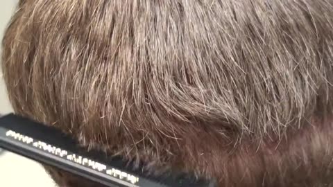 Dr. Brett Bolton No-Scar Hair Transplant at Suture Removal — Only 10 Days After!