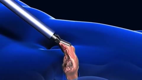 Prostate Glamd Removal Surgery (3D Animation)