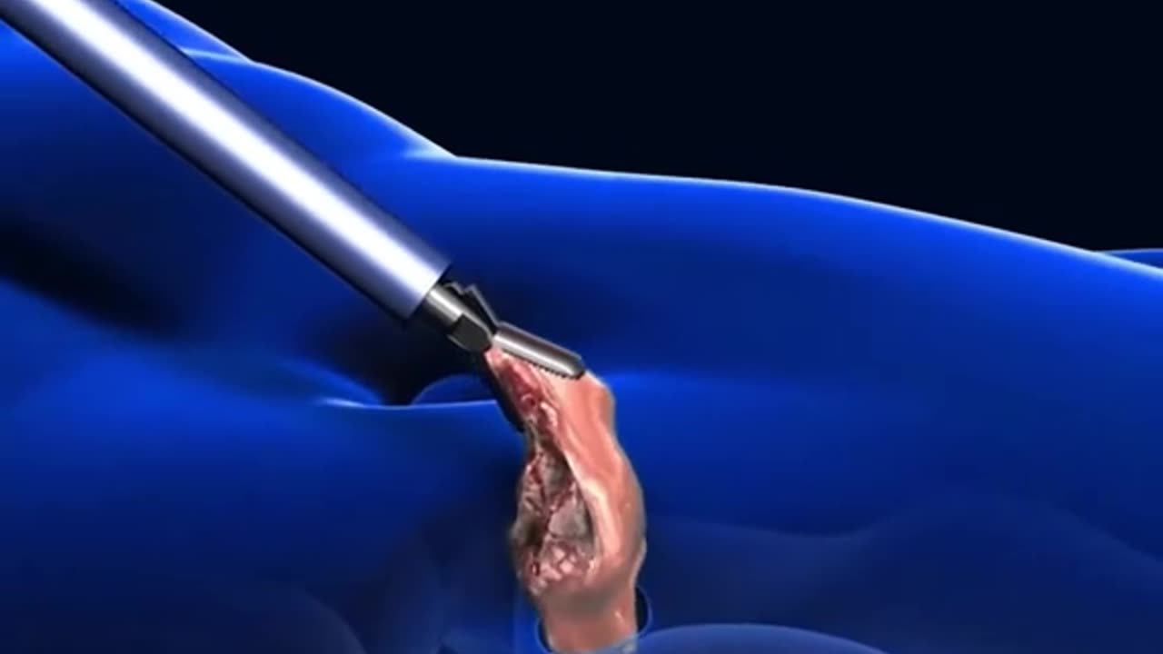 Prostate Glamd Removal Surgery (3D Animation)