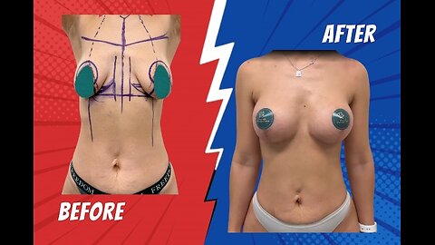 Plastic Surgery Truths | Asymmetries, Scars & Real Results Explained by Dr. Samir Ahire