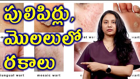 పులిపిర్లు, మొలలులో రకాలు Types of Warts Homeopahty Treatment Cure, Skintags Solutions | హోమియోపతి