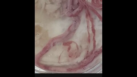 Bombshell New study Amyloids clots found in every people