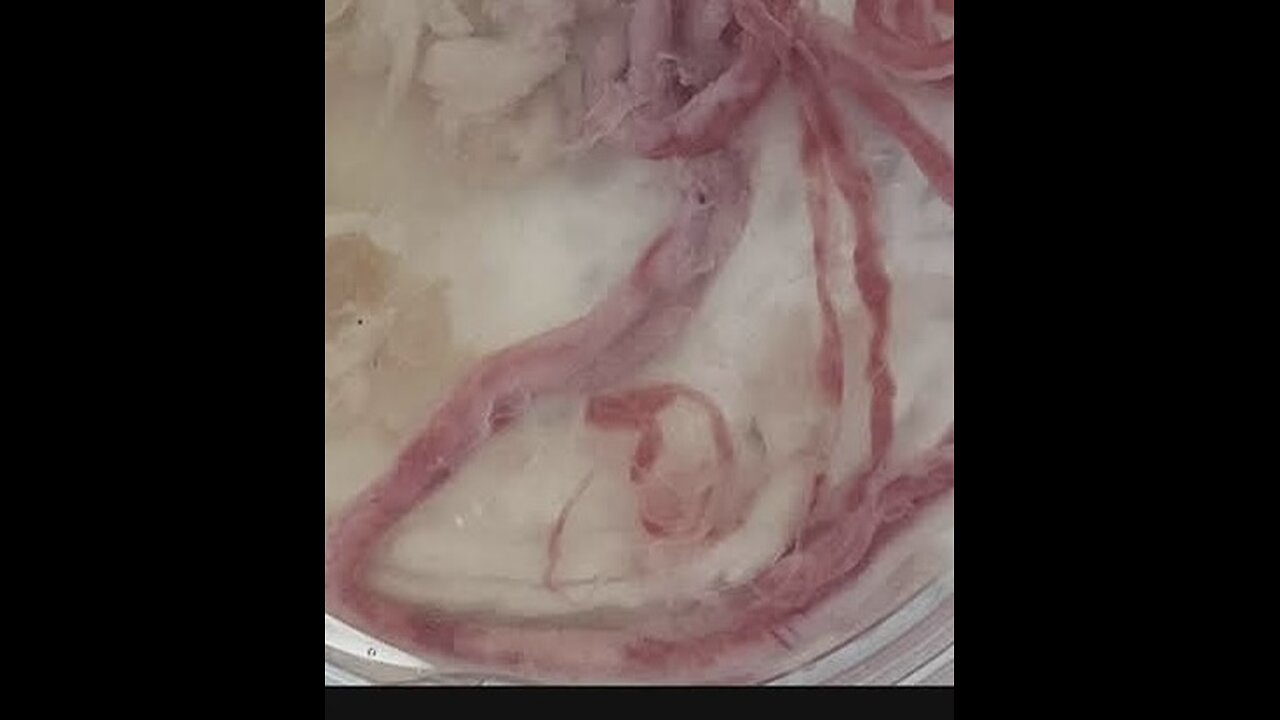 Bombshell New study Amyloids clots found in every people