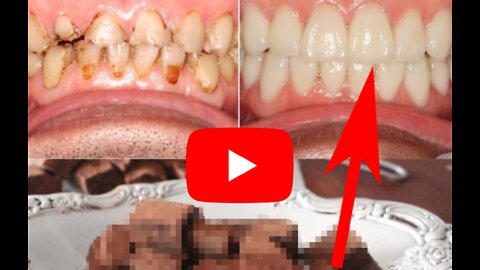 chew THIS soft “dental chocolate” to END oral decay