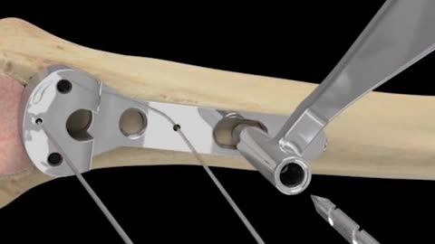 Distant Radioulnar Joint Arthroplasty 3D Animation (DRUJ Arthriplasty)