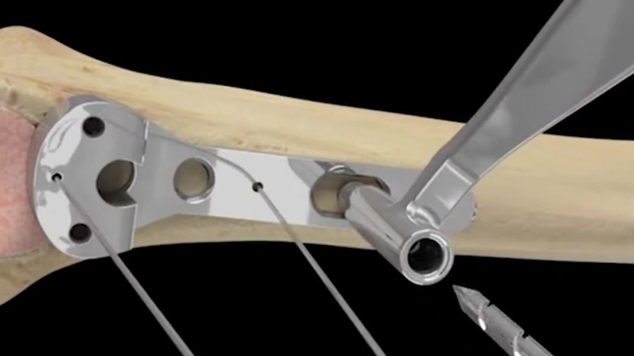 Distant Radioulnar Joint Arthroplasty 3D Animation (DRUJ Arthriplasty)