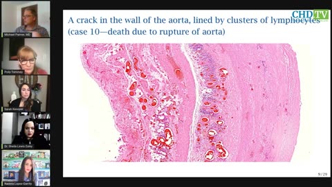 Covid Vaccines Evidence of Persistent Inflammation + Death in Autopsies — Michael Palmer, MD