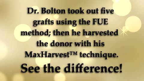 Dr. Brett Bolton Follicular Unit Extraction (FUE) Explained
