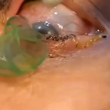 The girl had multiple contact lenses stuck in her eye. Be careful.