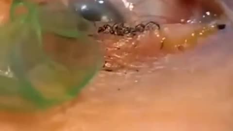 The girl had multiple contact lenses stuck in her eye. Be careful.