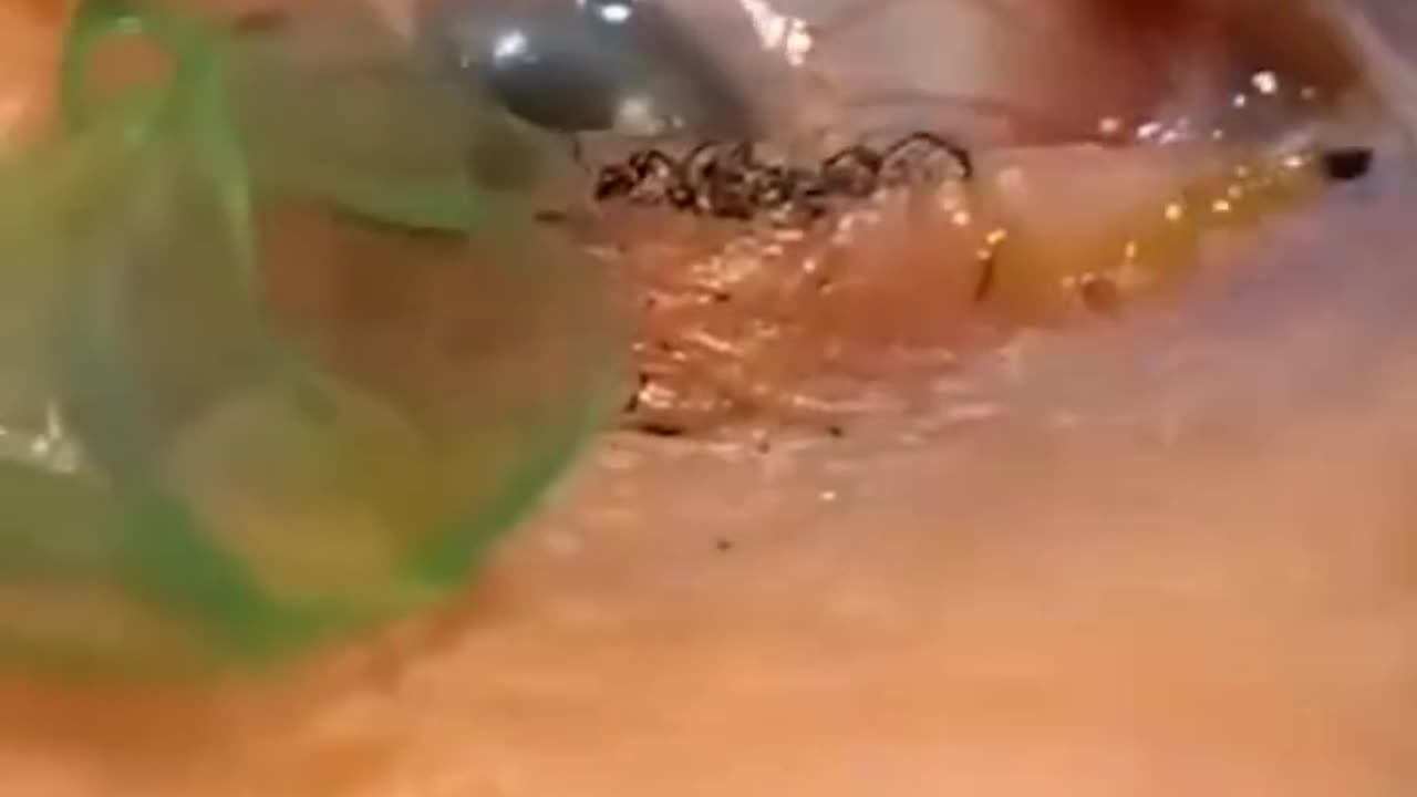 The girl had multiple contact lenses stuck in her eye. Be careful.