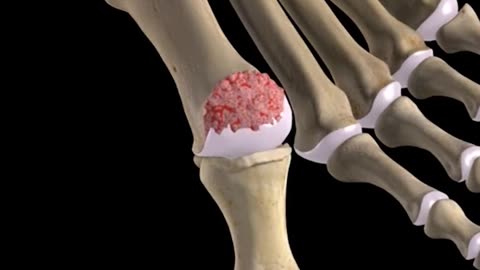 Cheilectomy Procedure 3D Animation (Bone Sprus Removal)