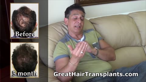 Dr. Brett Bolton Hair Restoration Transformation