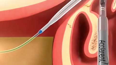 Ever Wonder How Doctors Clear Sinuses 👃💨