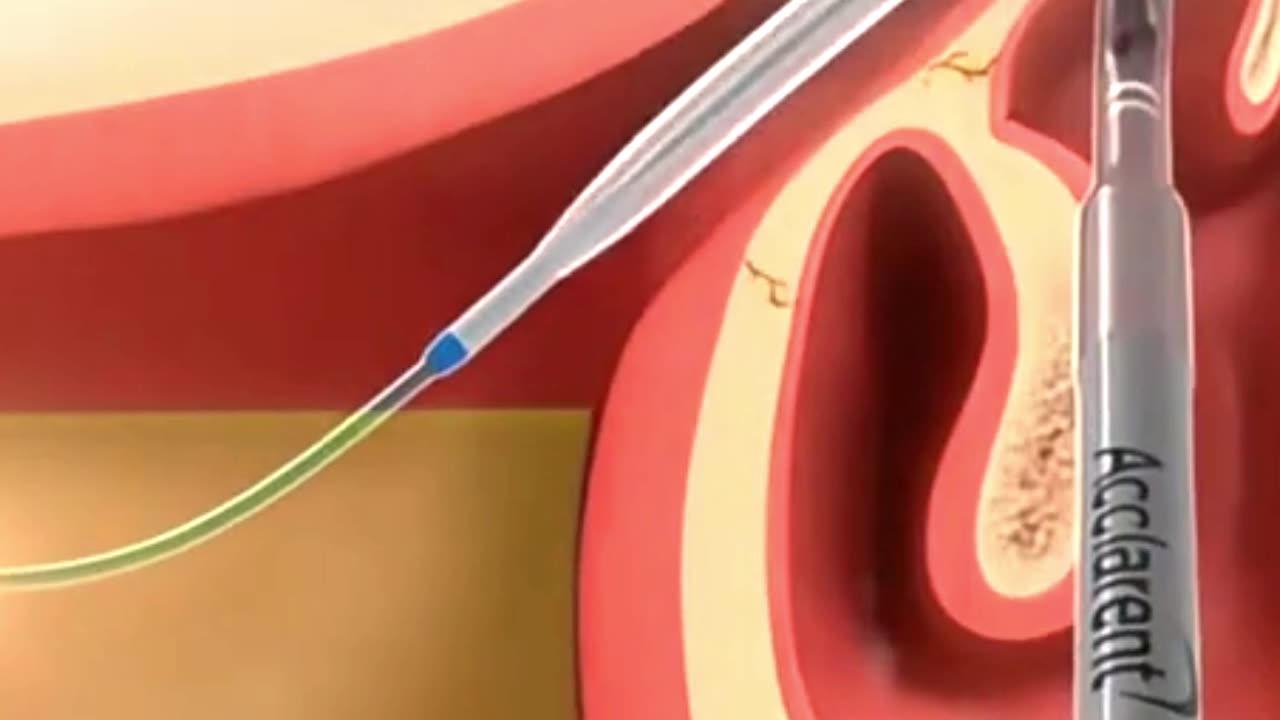 Ever Wonder How Doctors Clear Sinuses 👃💨