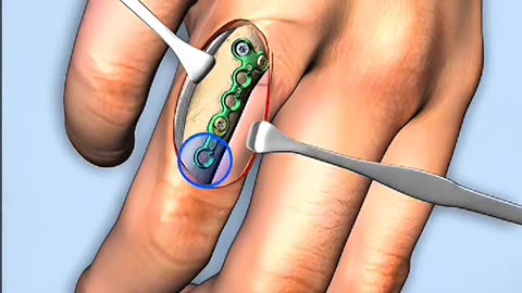 Finger Plating Surgery – Step by Step Medical Procedure Medical