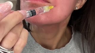 Treating My Nasolabial Folds with Hyaron