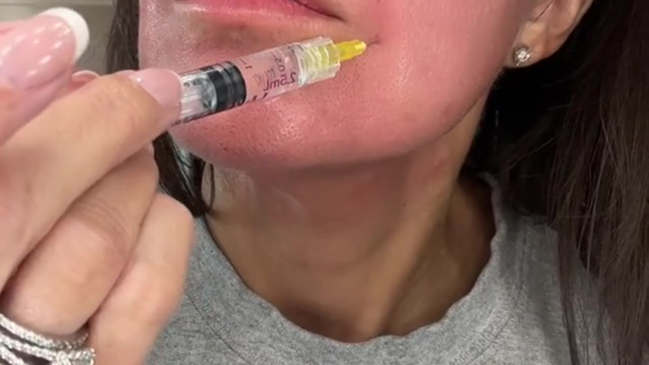 Treating My Nasolabial Folds with Hyaron