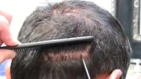 Dr. Brett Bolton Hair Implant Scar – See the Incredible Healing Results