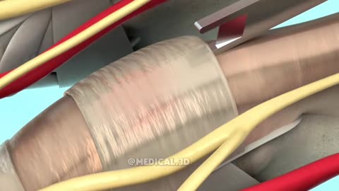 Trigger Finger Release Surgery (3D Animation)