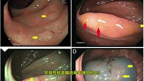 患結直腸癌 年輕人越來越多