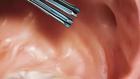 VALFOX Procedure To Treat Heart Mitral Valve