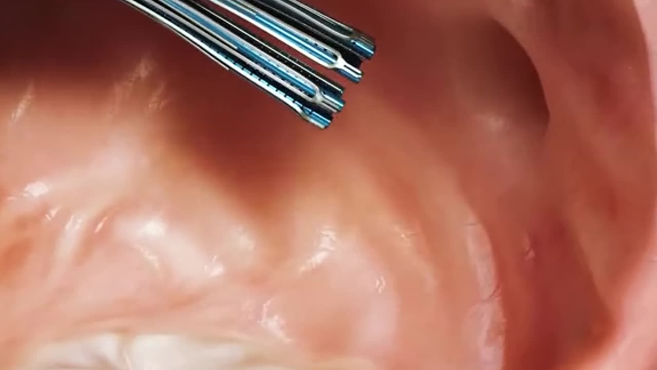 VALFOX Procedure To Treat Heart Mitral Valve