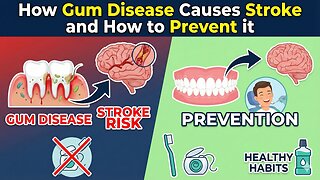 How Gum Disease Causes Stroke and How to Prevent it