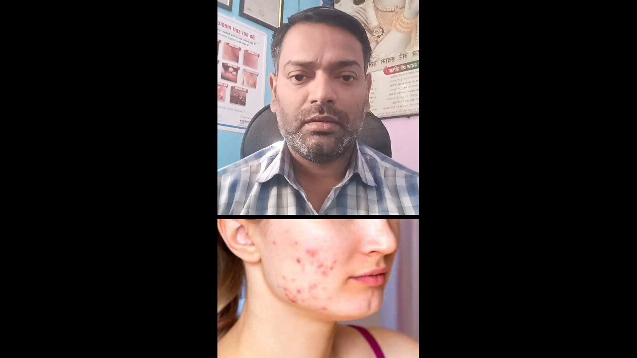 कील मुंहासों का इलाज ।