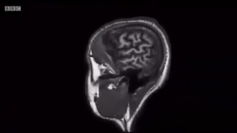 Your brain on an ultra-processed food diet