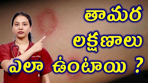 తామర లక్షణాలు ఎలా ఉంటాయి? Signs and Symptoms of Tinea or Ringworm Homeopathy Treatment | హోమియోపతి\