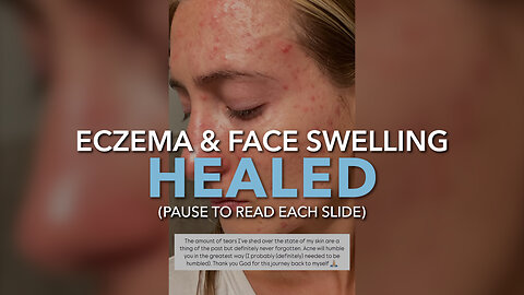 Eczema & Face Swelling Healed