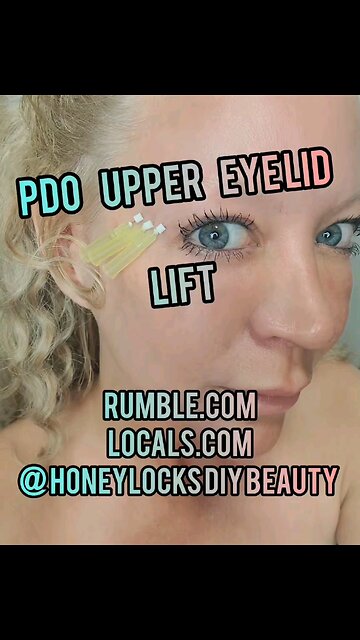 PDO Facial Threads Orbital Ridge/Upper Eyelid Edited Version 🤩