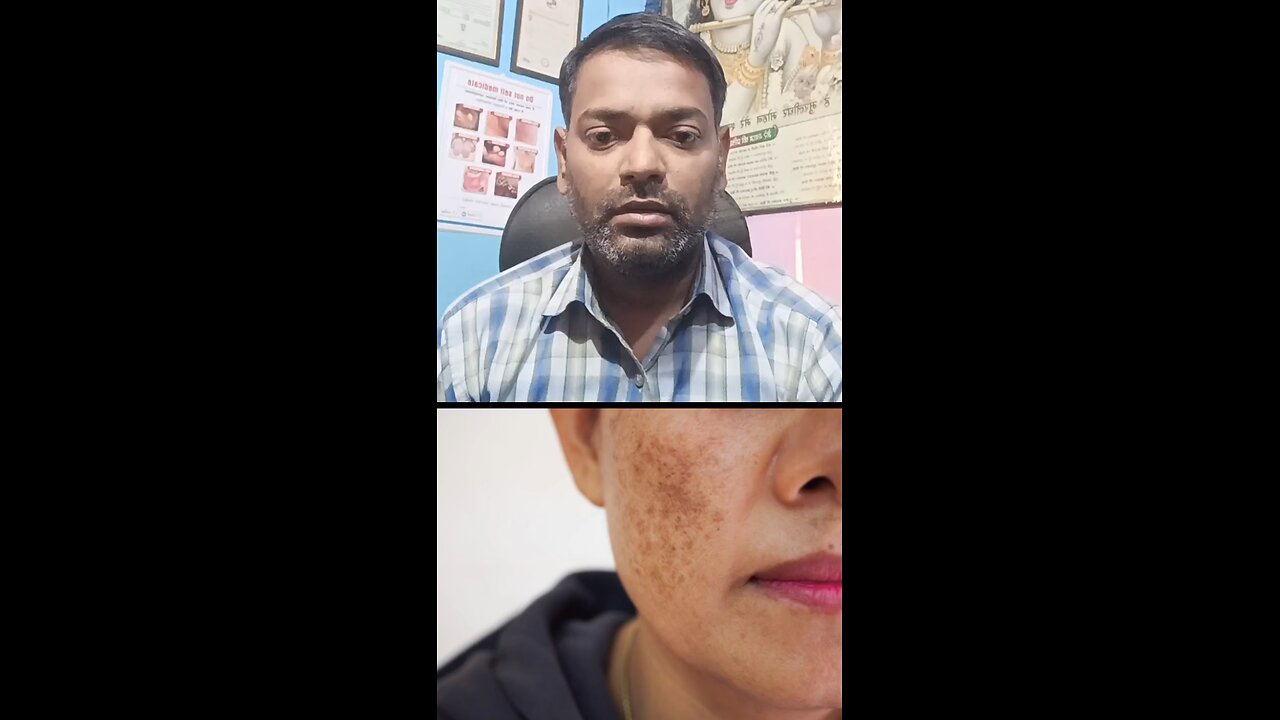 झाइयों का इलाज ।