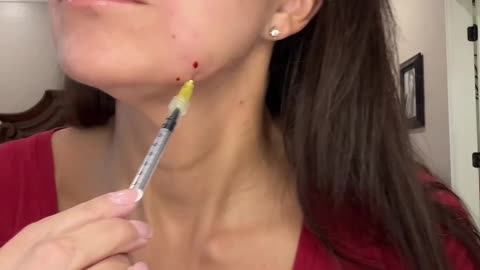 Round 2 fat dissolver in jowels with Super V-Line Sol