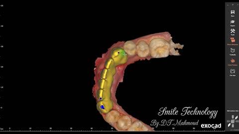 #design #naildesign #dental #dentaldesign #exocadexpert