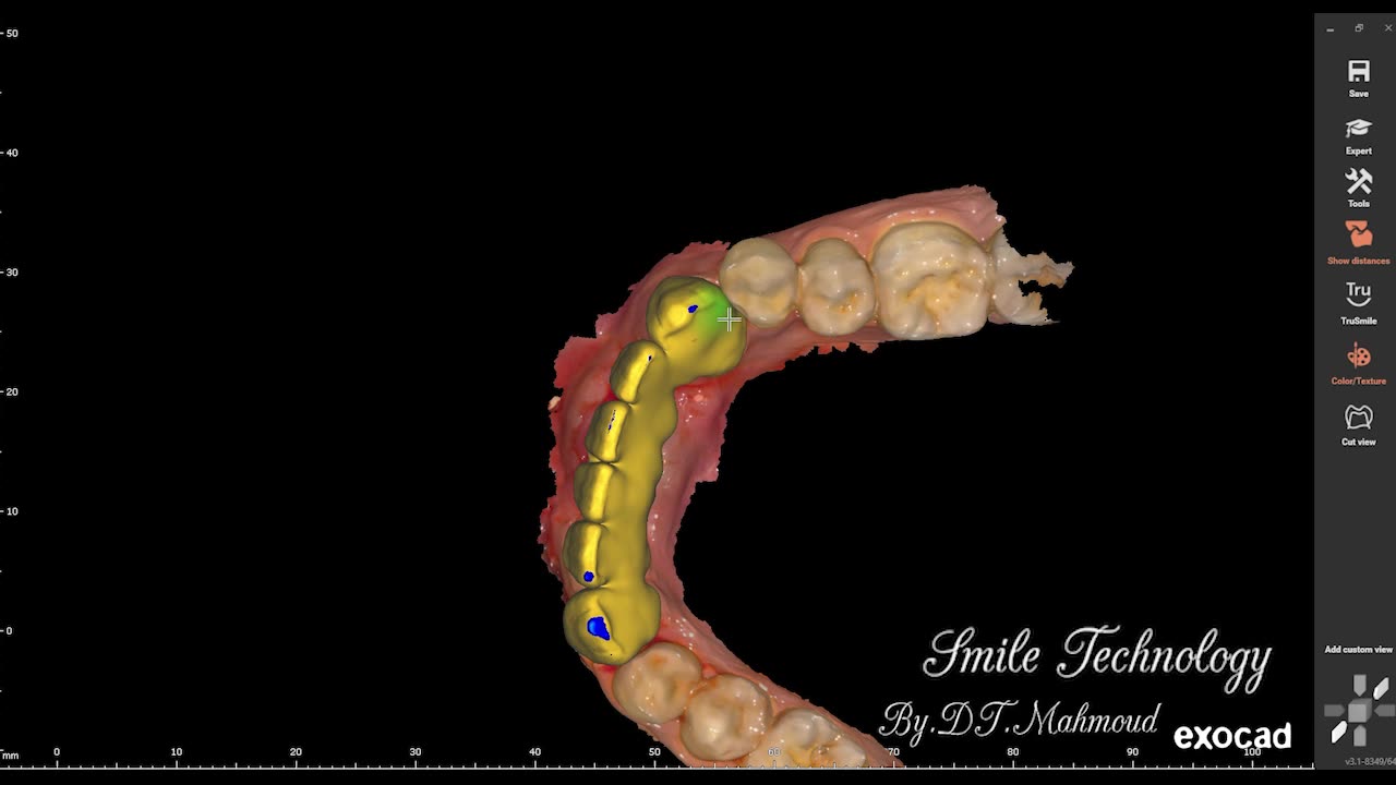 #design #naildesign #dental #dentaldesign #exocadexpert