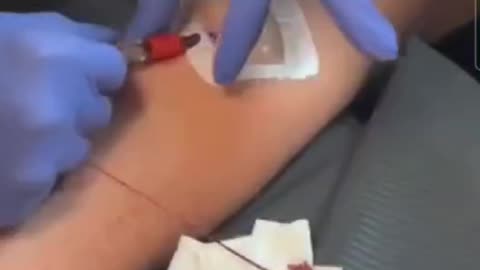 Blood clot pulled right out of jew jab recipient's arm on camera