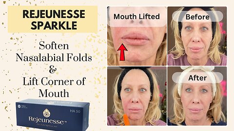 Rejeunesse Sparkle - Soften Nasolabial Folds & Lift Corner of Mouth