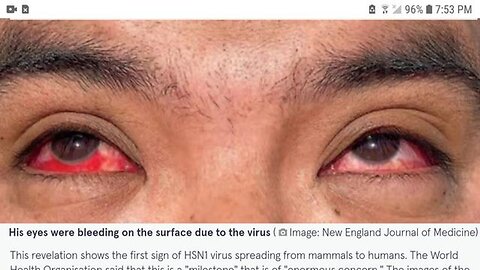 BIRD FLU BLEEDING EYEBALLS? (WARNING GRAPHIC CONTENT)