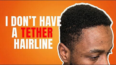 A Foreigner Brags About His Hairline, And This Happened