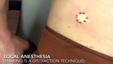 Excision of one of two lipomas Part I For medical education NSFE