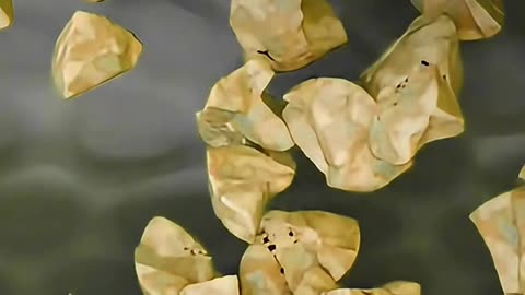 How Doctors Remove Gallbladder Stones Without Opening the Abdomen